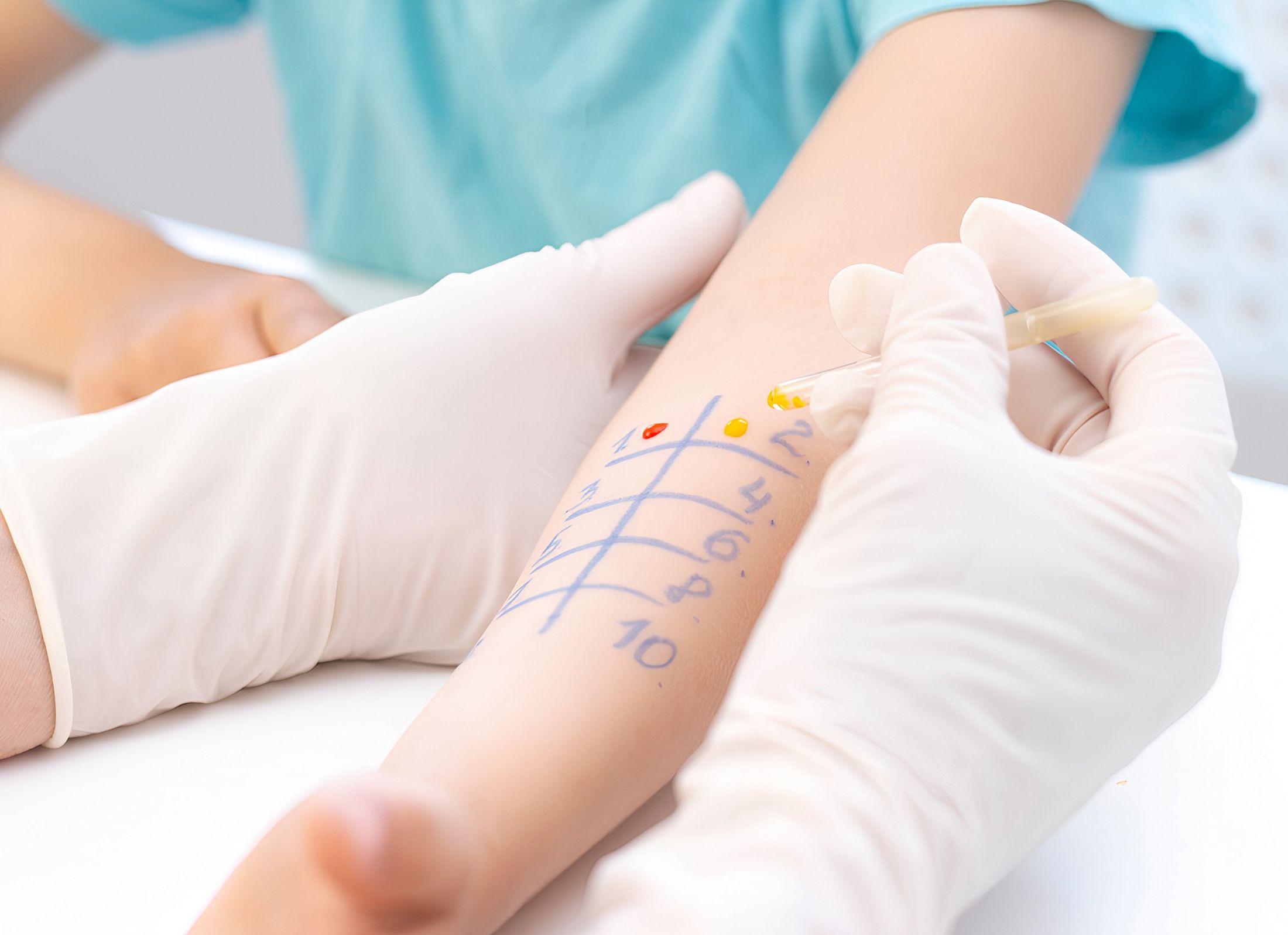 Allergy testing in progress on a child's arm.